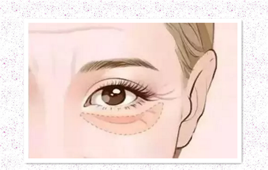 嗨体可以打泪沟吗 嗨体填充救泪沟你要知道这些