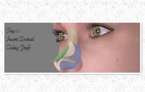 达拉斯隆鼻的危害 常见4大让你痛苦的危害如何避免