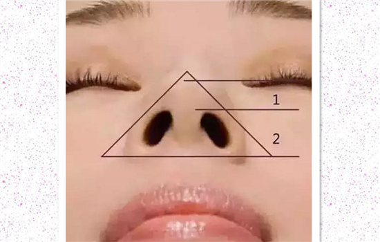 达拉斯隆鼻步骤 解析达拉斯隆鼻详细过程