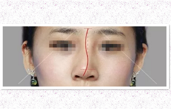 L型假体隆鼻优缺点 做L型假体不知道这些会被害惨