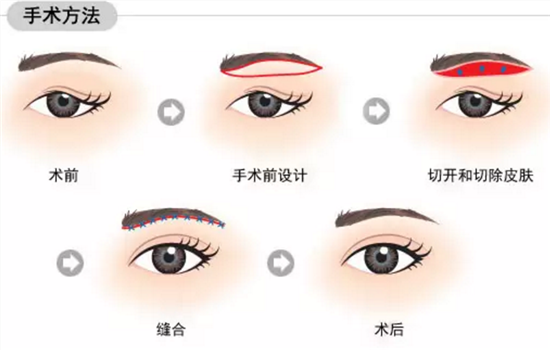 切眉手术几天拆线 保证快速拆线的秘诀赶紧拿去