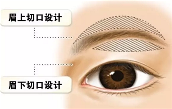 切眉手术几天拆线 保证快速拆线的秘诀赶紧拿去