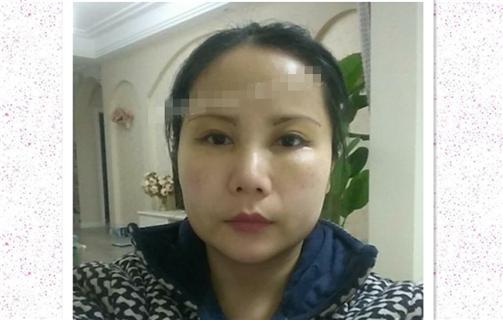 切眉手术恢复过程图 做完手术眼皮就能上提吗女人必看