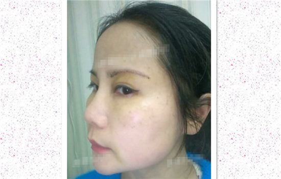 切眉手术恢复过程图 做完手术眼皮就能上提吗女人必看