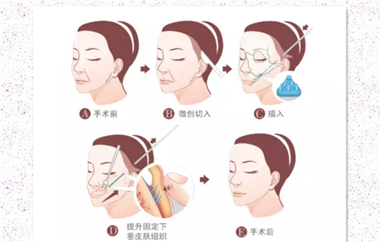 切眉手术后怎样消肿快 尤其是第二个方法最让人想不到