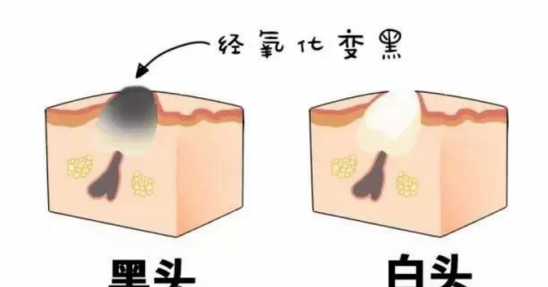 去黑头最有效的方法 怎么去黑头比较好吗