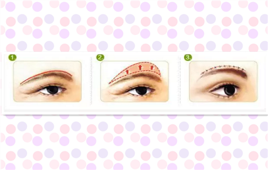 切眉眉下切好还是眉上好 揭晓你不知道的切眉秘密