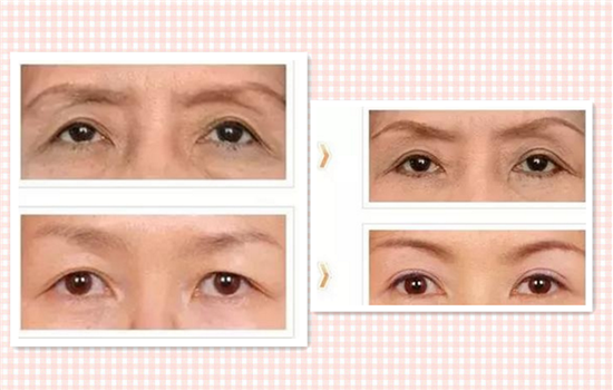 切眉毛的好处 最后一个好处你一定得知道