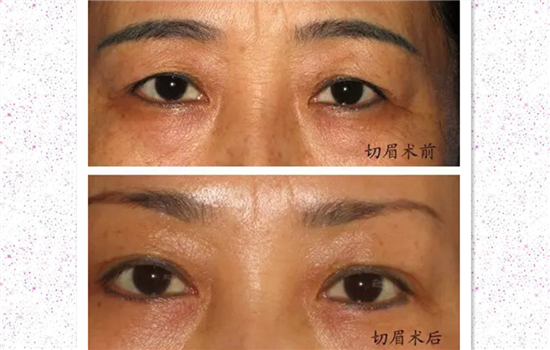 切眉不自然怎么办 这三个方法让你快快好起来