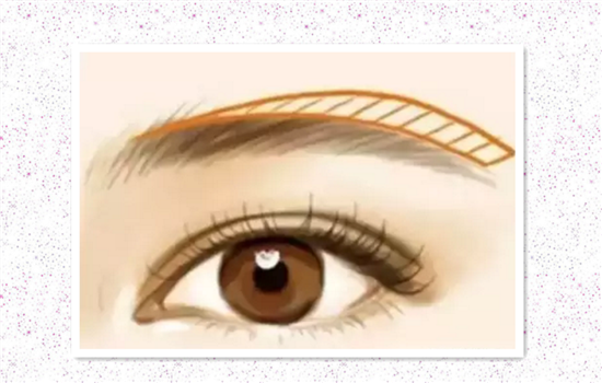 眉上切口提眉图片 切眉前不可不看的图片