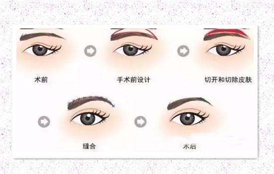 眉上切口提眉图片 切眉前不可不看的图片