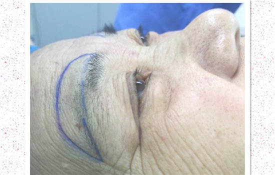 眉上切口提眉图片 切眉前不可不看的图片