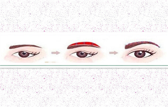 提眉拆线后注意事项 提眉术后必须做的9件事