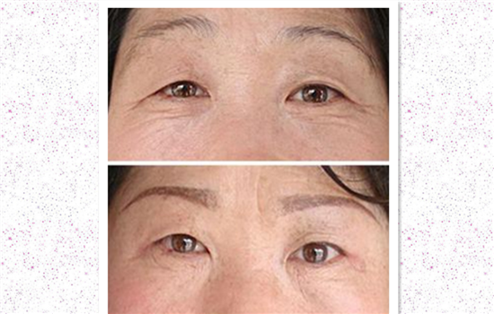 切眉手术失败的图片 切眉没做好会成什么样有图有真相