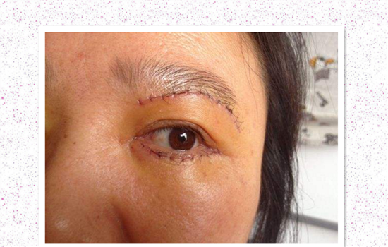 切眉手术后老得快吗 教你怎样避免被切眉术害惨