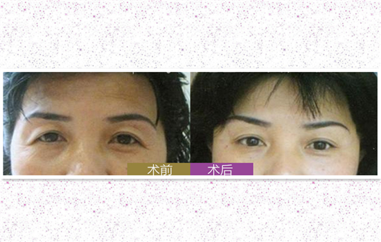 切眉毛前后对比照片 令人称奇的切眉效果有图有真相