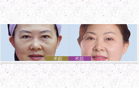 切眉毛前后对比照片 令人称奇的切眉效果有图有真相