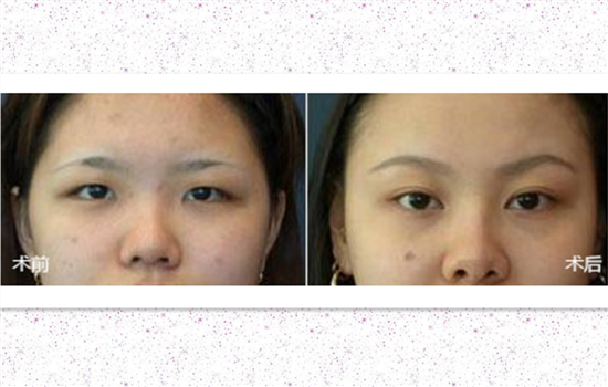切眉毛前后对比照片 令人称奇的切眉效果有图有真相