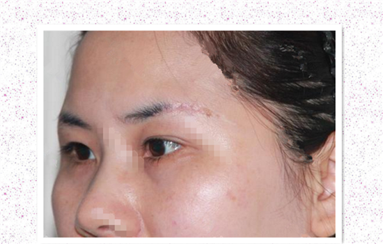 切眉一年后疤痕图片 切眉者手术前不得不看的图片
