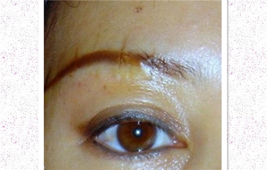 切眉一年后疤痕图片 切眉者手术前不得不看的图片
