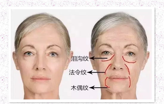 大v线分几种 线雕前一定要知道防被忽悠