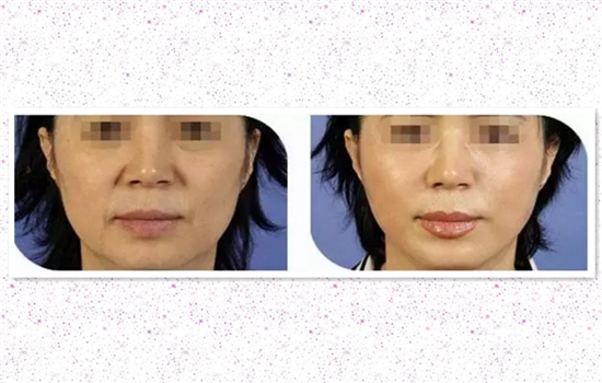 大v线和小v线的区别 你一定要收藏的线雕干货