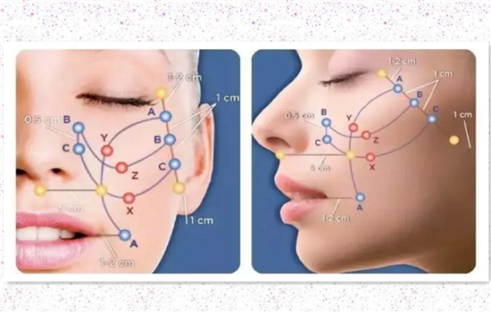 大v线提升一般用几根线 埋少了线基本等于没做