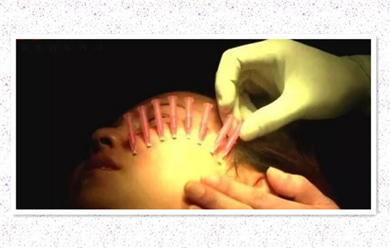 大v线会断吗 选择非法线雕或发生让你大惊失色的后果