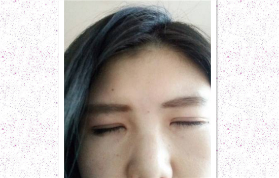全切双眼皮恢复过程图 看完不那么害怕割双眼皮了