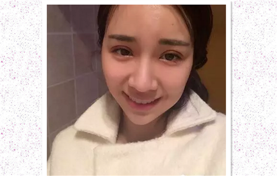 全切双眼皮过程 想做双眼皮手术的姑娘看后惊呆