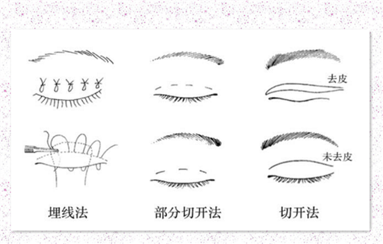 什么是全切双眼皮 干货文让你更了解全切双眼皮