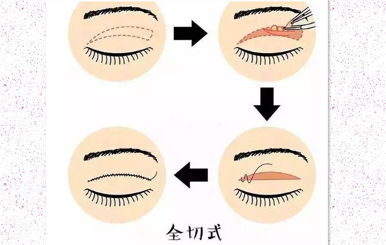什么是全切双眼皮 干货文让你更了解全切双眼皮