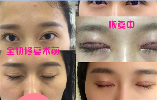 什么是全切双眼皮 干货文让你更了解全切双眼皮