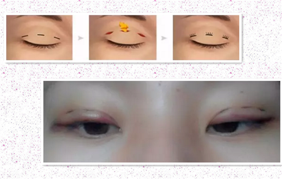 割双眼皮分为几种 强烈推荐的双眼皮术式解析