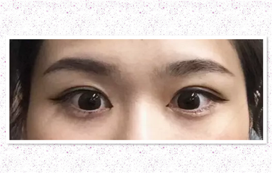 割双眼皮过程感受 达人亲历双眼皮手术高清图胆小勿入