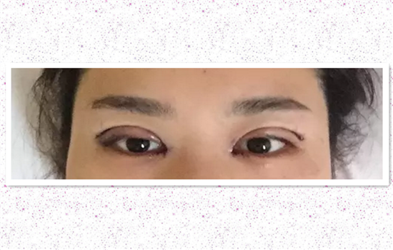 割双眼皮过程感受 达人亲历双眼皮手术高清图胆小勿入