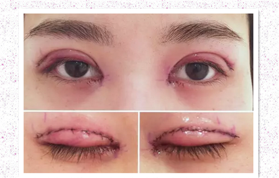 割双眼皮过程感受 达人亲历双眼皮手术高清图胆小勿入