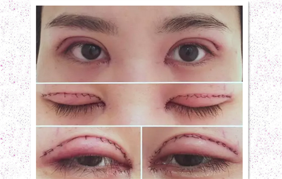 割双眼皮过程感受 达人亲历双眼皮手术高清图胆小勿入