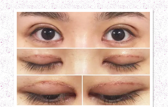 割双眼皮过程感受 达人亲历双眼皮手术高清图胆小勿入