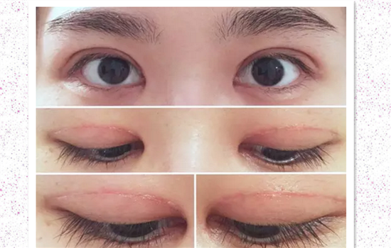 割双眼皮过程感受 达人亲历双眼皮手术高清图胆小勿入