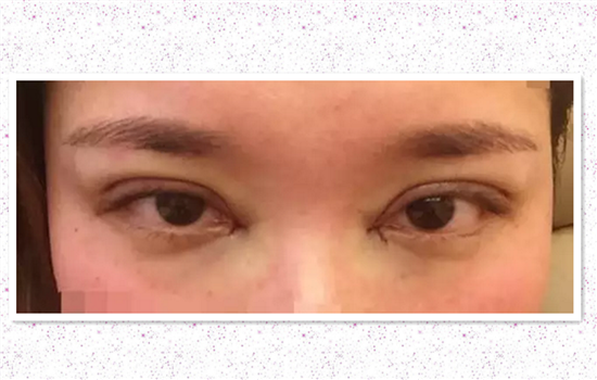 全切双眼皮加开眼角多久恢复 达人亲历有图有真相