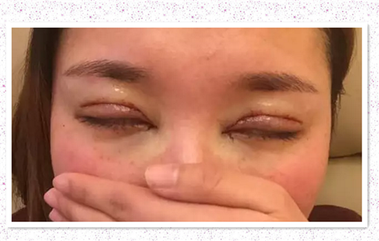 全切双眼皮加开眼角多久恢复 达人亲历有图有真相