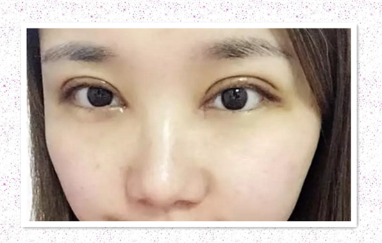 全切双眼皮加开眼角多久恢复 达人亲历有图有真相