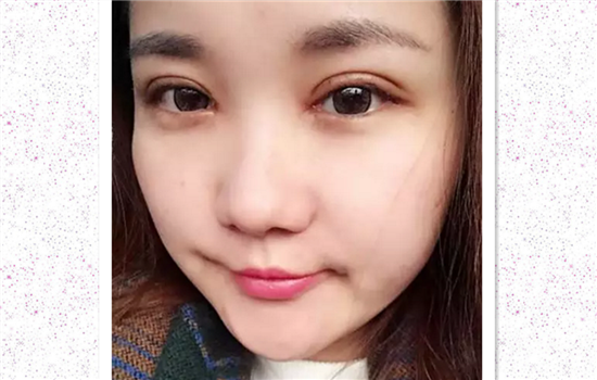 全切双眼皮加开眼角多久恢复 达人亲历有图有真相