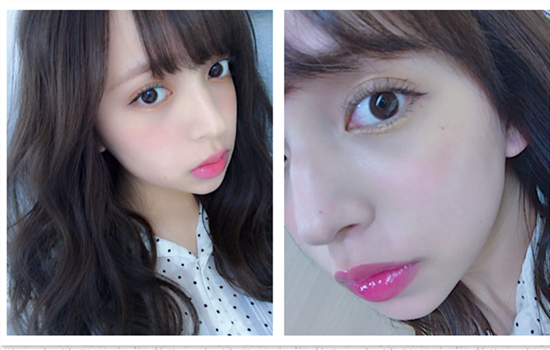 全切双眼皮几天拆线 拆线后一定要懂如何避免感染留疤