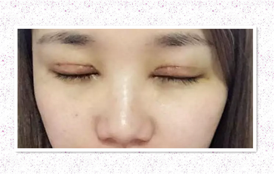 全切双眼皮几天拆线 拆线后一定要懂如何避免感染留疤