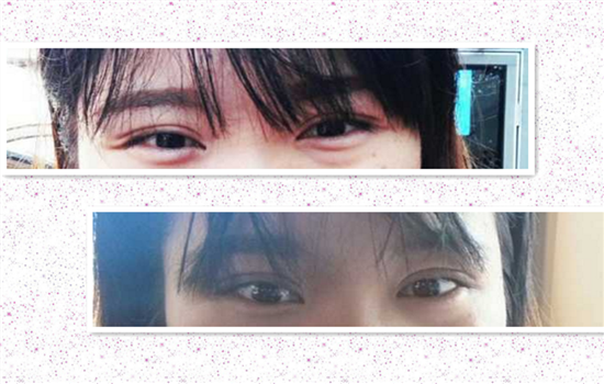 全切双眼皮可以修复么 修复手术的秘密你一定要知道