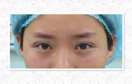 割了双眼皮多久可以种睫毛 眼部化妆美容都应该多注意