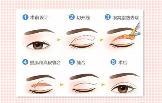 全切双眼皮留疤怎么办 值得收藏的双眼皮手术秘密