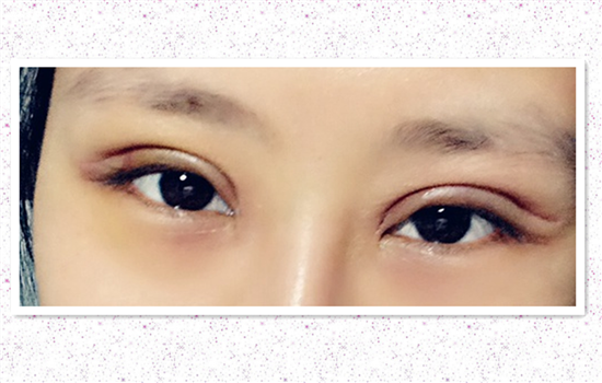 全切双眼皮留疤怎么办 值得收藏的双眼皮手术秘密